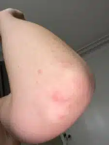 Piqure Punaise de Lit Traitement