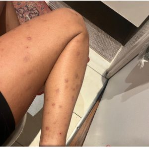 Photos de piqures de larves d’anthrènes de tapis