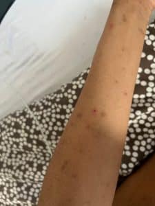 Photos de piqures de larves d’anthrènes de tapis